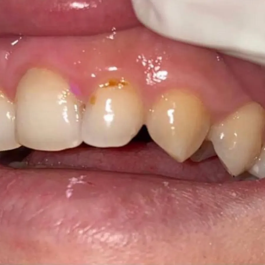 Prima - Corone estetiche